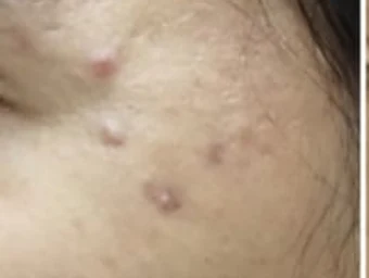 Marcas de acné en la mejilla, antes del tratamiento.