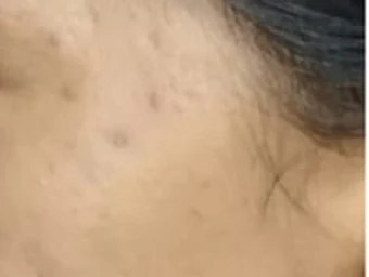 Marcas de acné en la mejilla, después del tratamiento.